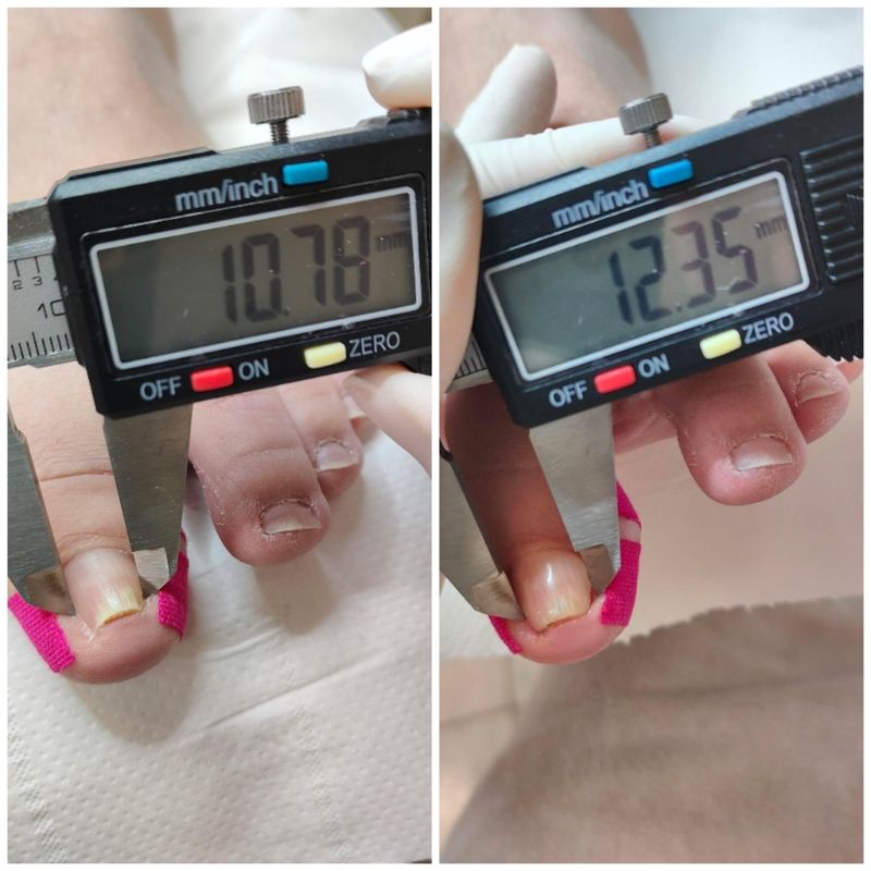 primer postopka za ukrivljen noht